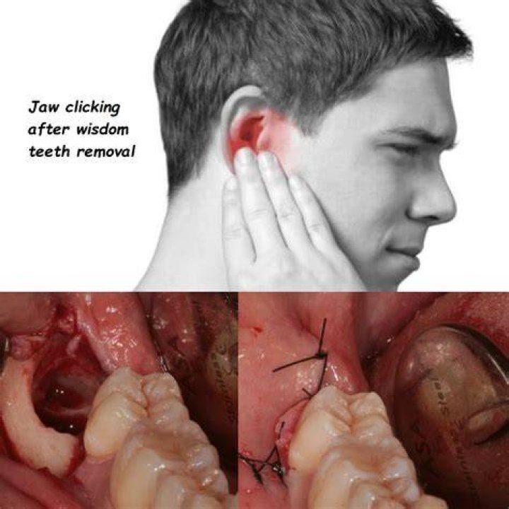 Are earaches common after wisdom teeth removal?