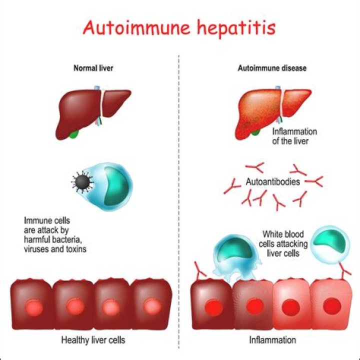 Can autoimmune hepatitis be transmitted?
