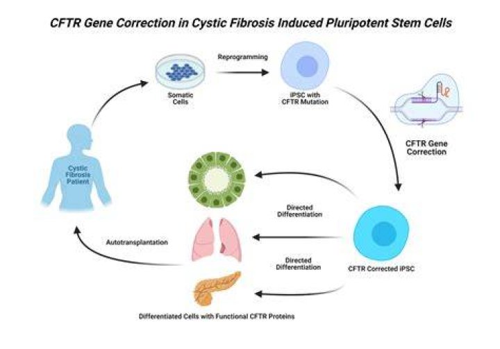 Can cystic fibrosis be cured by gene therapy?