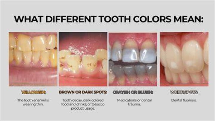 Can dehydration cause tooth discoloration?