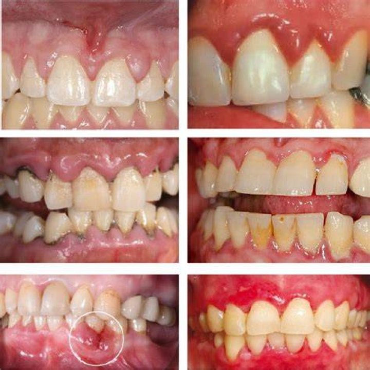 Can doxycycline cause gum pain?