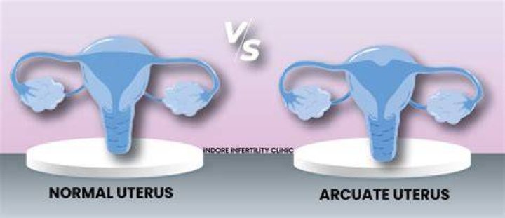 Can having an arcuate uterus affect pregnancy?