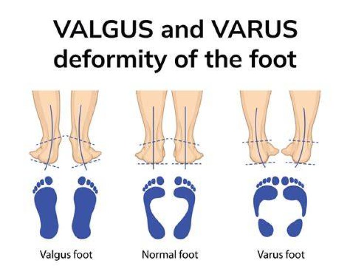 Can hindfoot valgus be fixed?