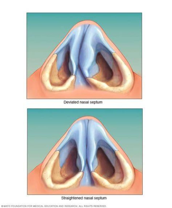 Can I get a deviated septum fixed on NHS?