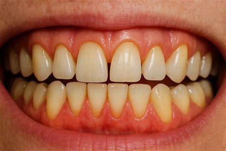 Can mouthwash reverse receding gums?