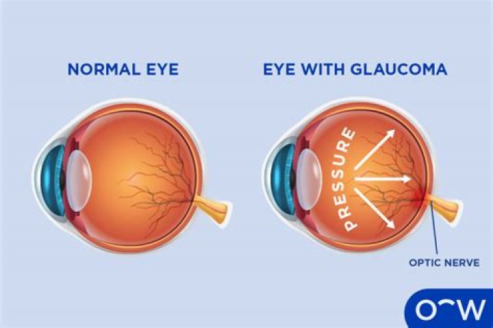 Can people with glaucoma fly in an airplane?