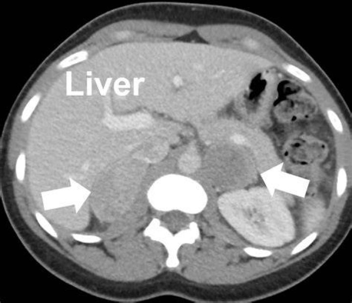 Can pheochromocytoma be malignant?