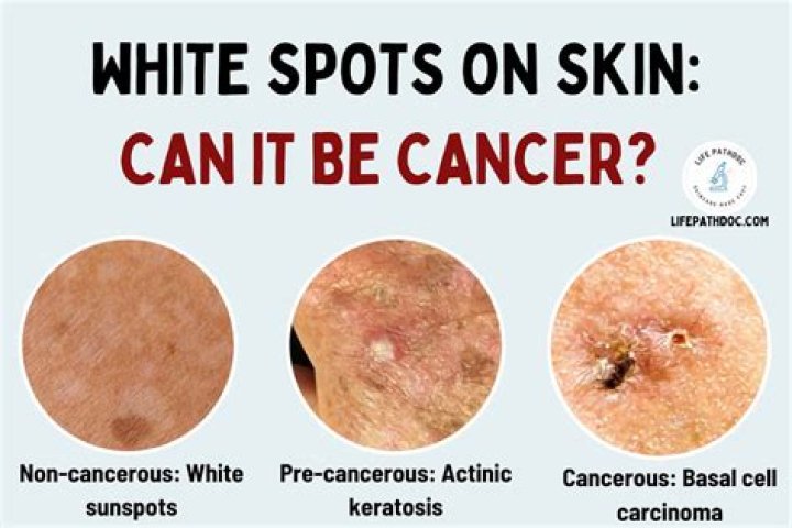 Can skin cancer look like white spots?