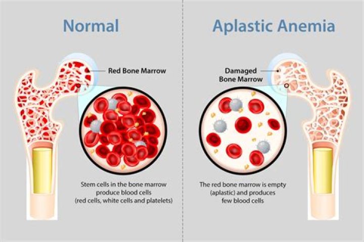 Can stem cells cure aplastic anemia?