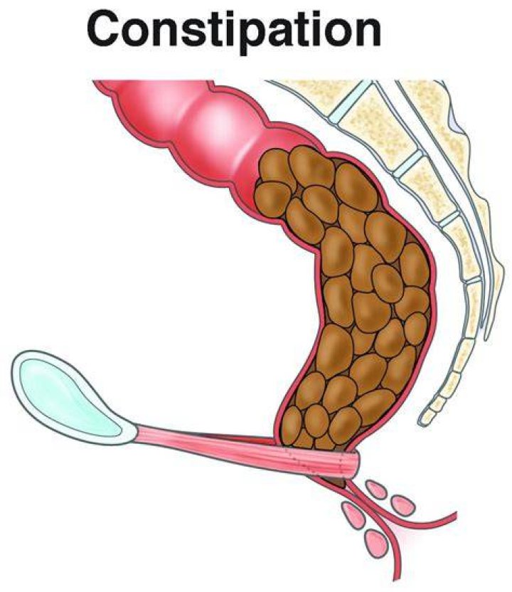 Can you be constipated and not feel it?