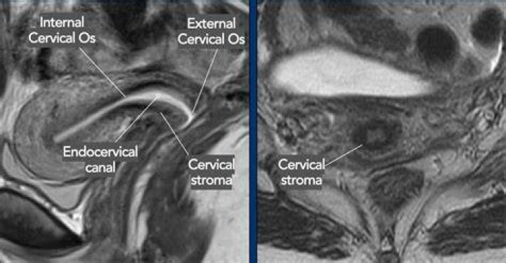 Can you see cervix on MRI?