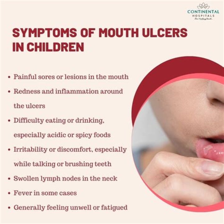 Can you use bonjela on mouth ulcers kids?