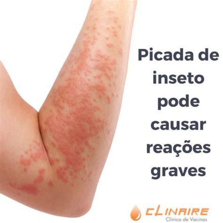 Como tratar a balanite causada por alergia?