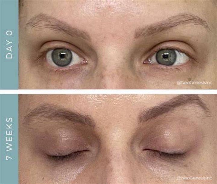 Do eyebrows grow back after thyroid?