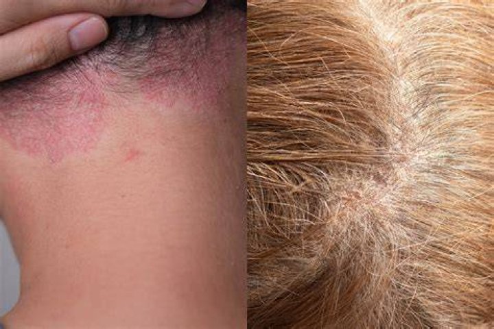 Does eczema cause body hair loss?