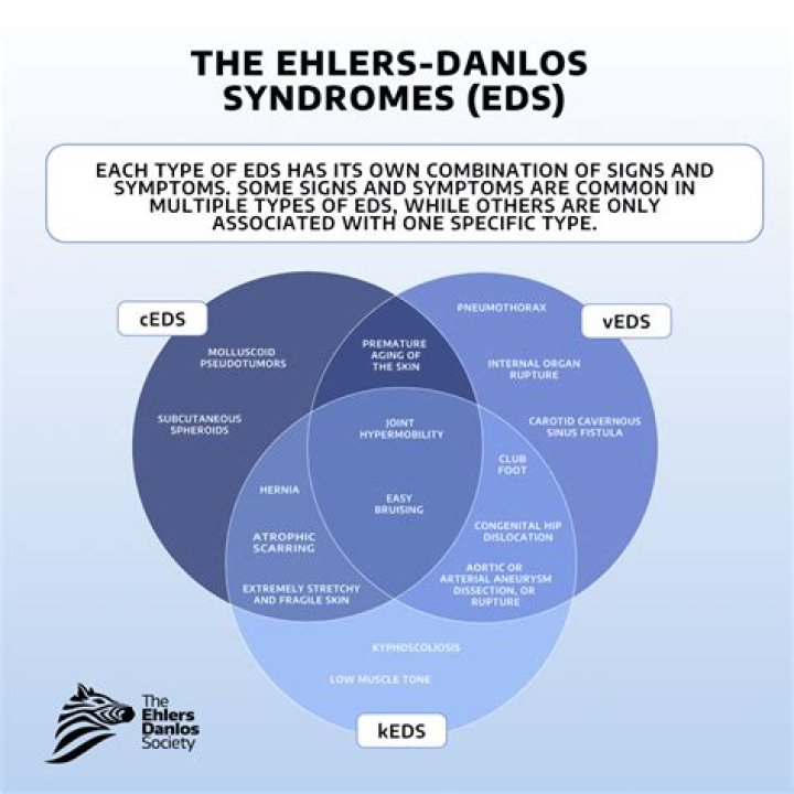 Does EDS affect the ears?