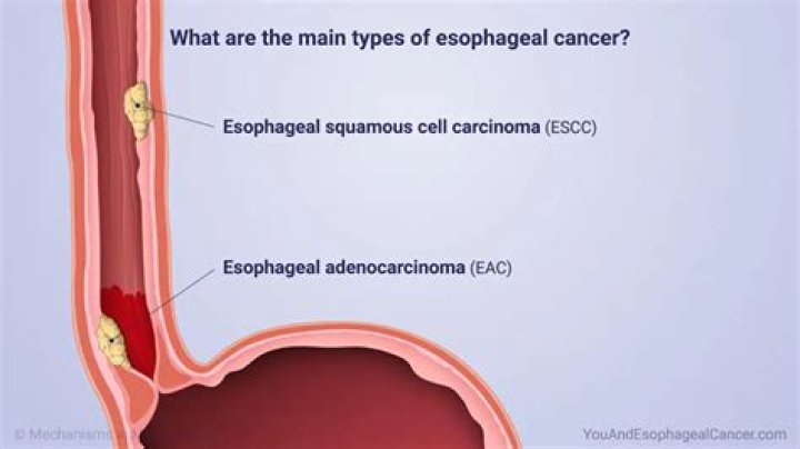 Does esophageal cancer show up on barium swallow?