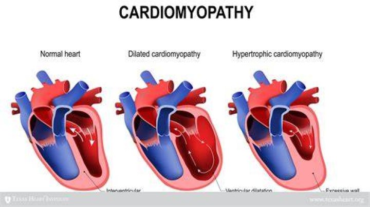 Does hypertrophic cardiomyopathy show up on ECG?