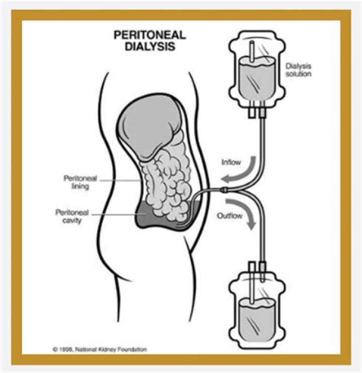 Does peritoneal dialysis use diffusion or osmosis?