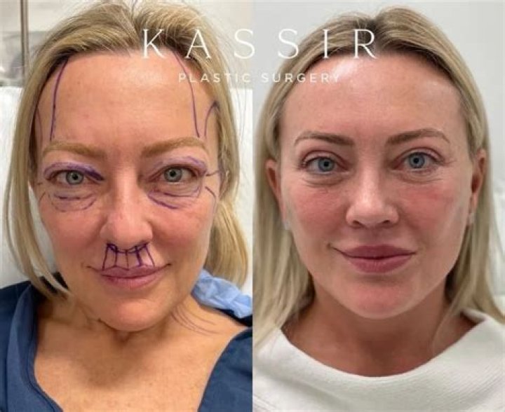 Does plastic surgery make your face puffy?