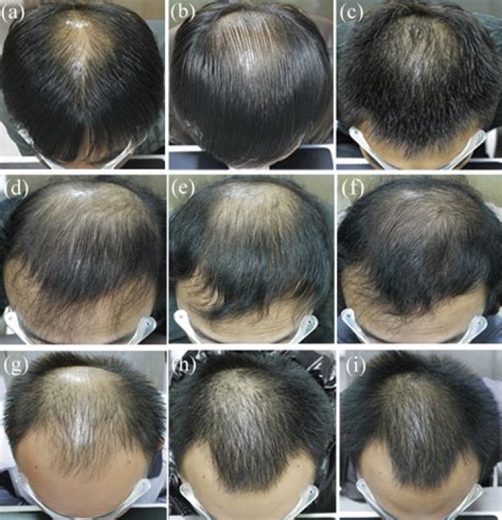 Does selenium regrow hair?