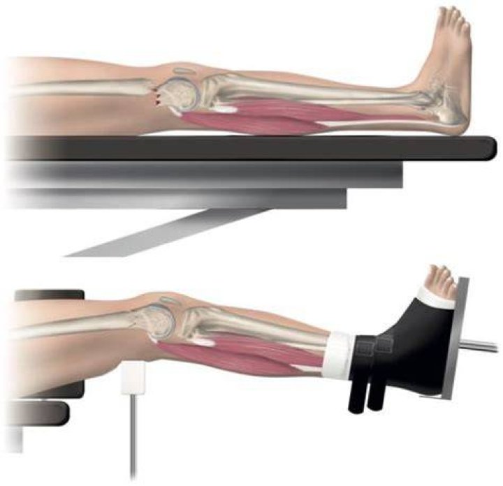 Does traction help knee pain?