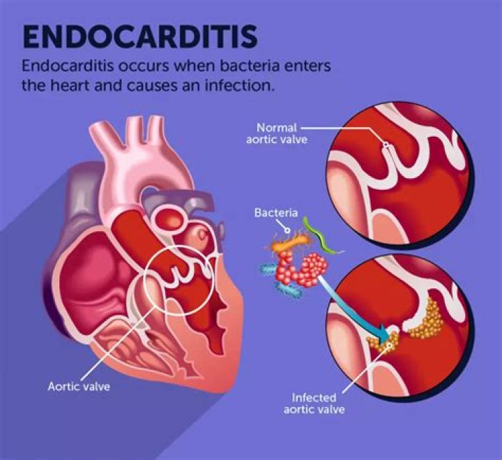 How can you reduce the risk of infective endocarditis?