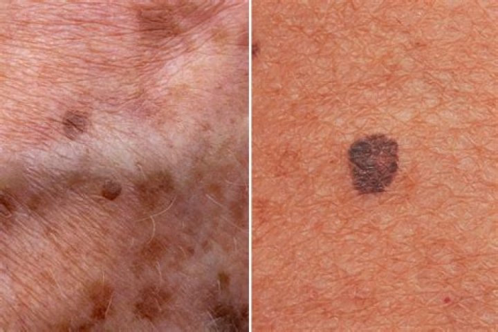 How can you tell the difference between melanoma and nevus?