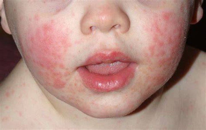 How contagious is slapped cheek?