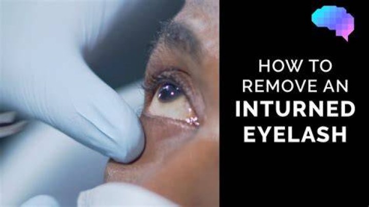 How do you bill for eyelash epilation?
