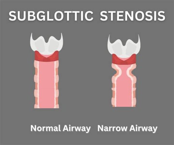 How do you fix subglottic stenosis?