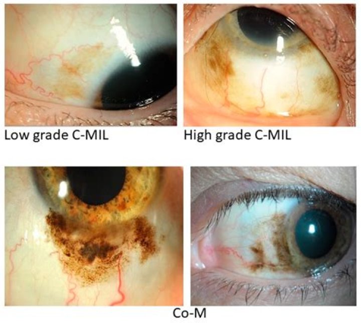 How do you get rid of conjunctival melanosis?