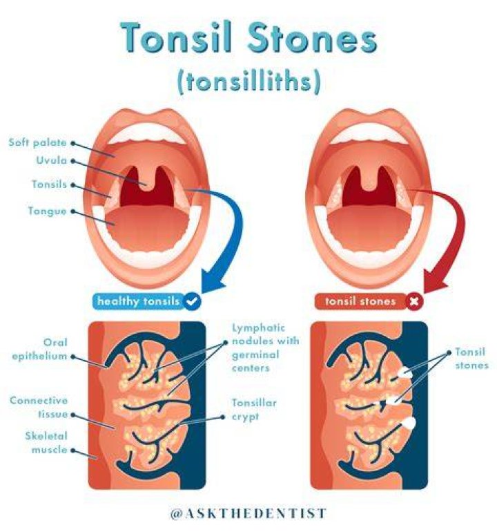 How do you get rid of deep tonsil stones?
