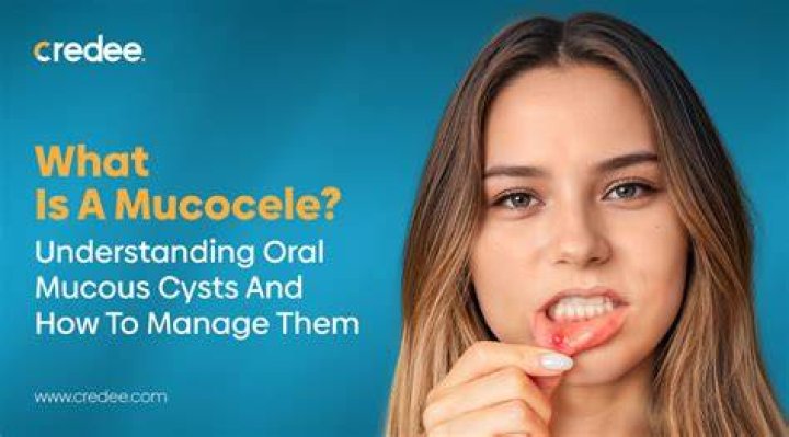 How do you treat a superficial mucocele?