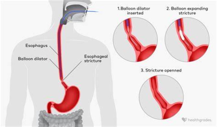 How do you treat an inflamed stomach and esophagus?