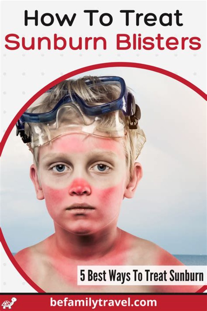 How do you treat sun rash blisters?