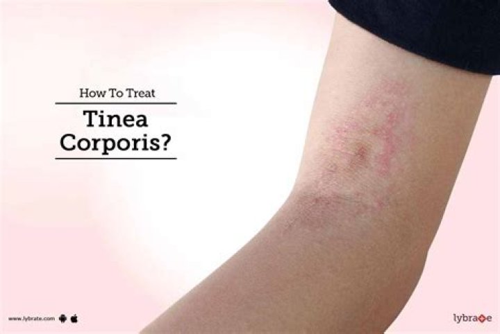 How do you treat tinea corporis?