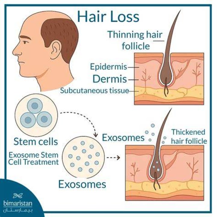 How effective is exosomes for hair loss?