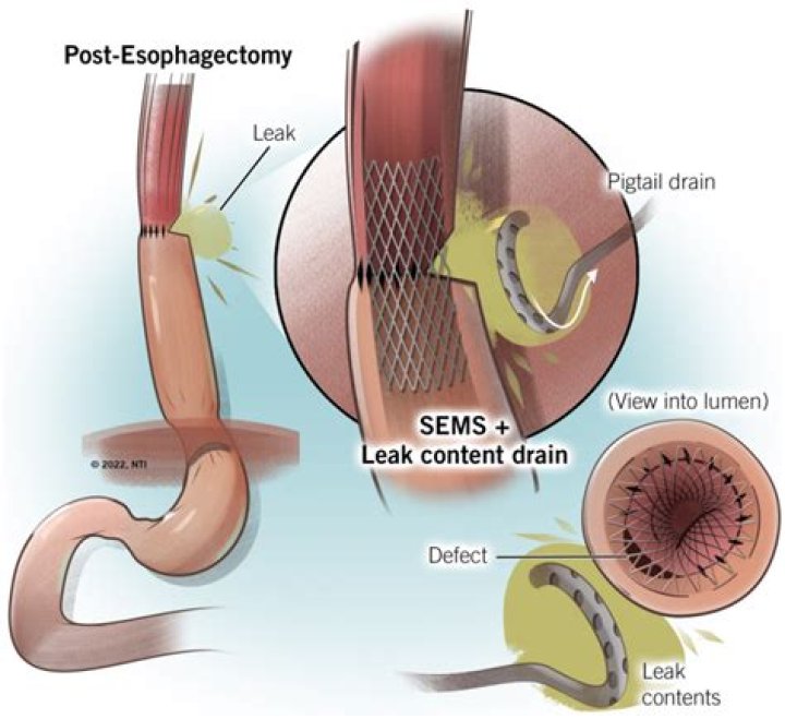 How is anastomotic leak treated?