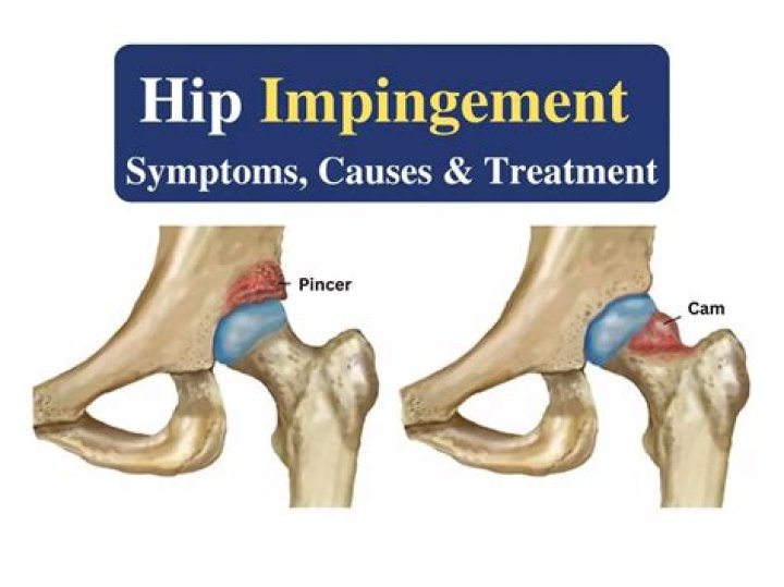 How is ischiofemoral impingement treated?