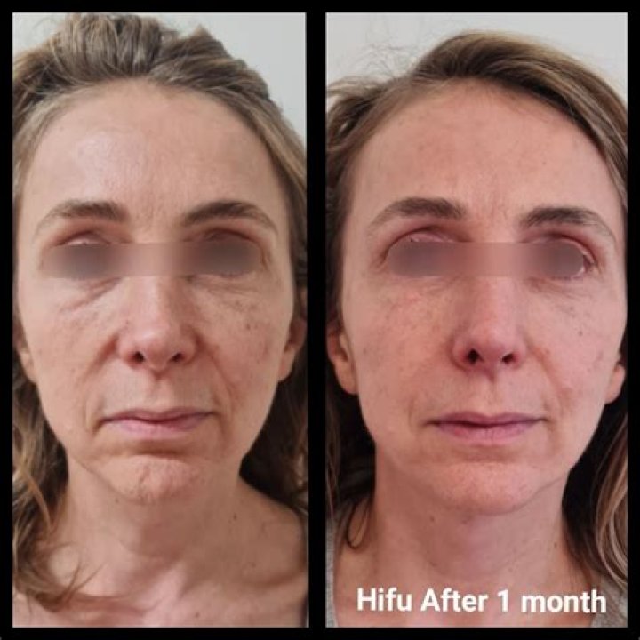 How long does a CACI face lift last?