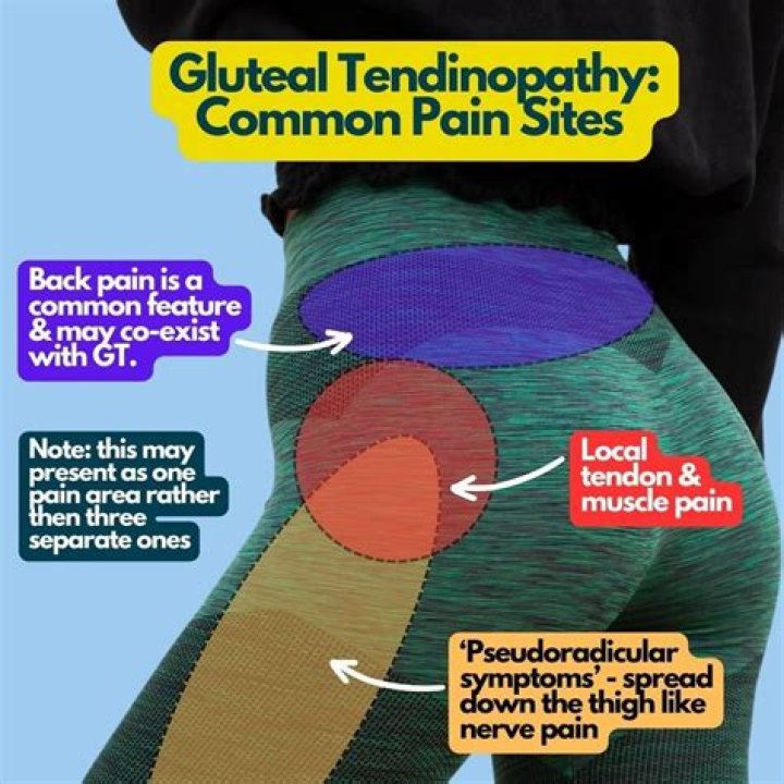 How long does gluteal tendonitis last?