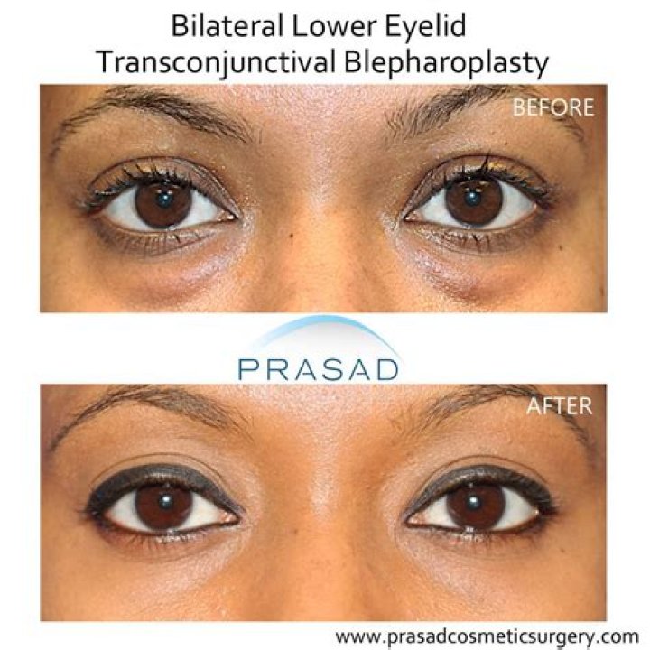 How long does non-surgical blepharoplasty?
