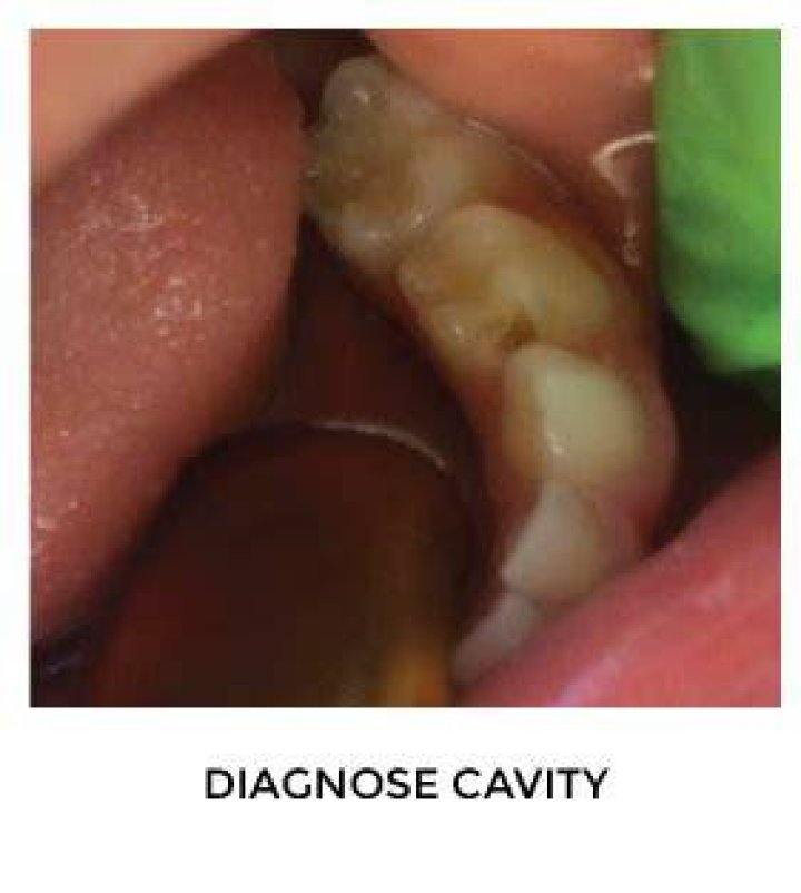 How long does SDF last on teeth?