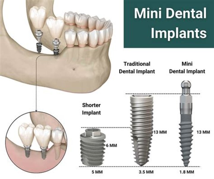 How much are mini implants in Mexico?