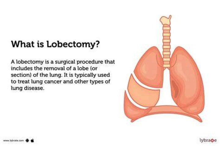 How painful is a lung lobectomy?