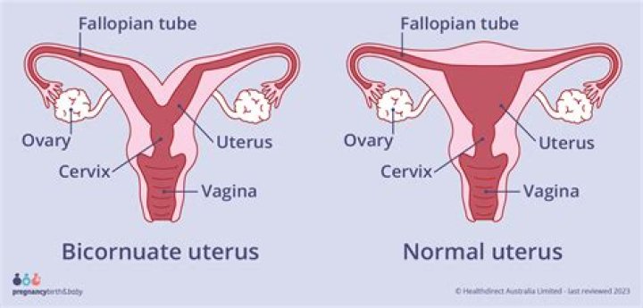 Is a bicornuate uterus considered high risk pregnancy?