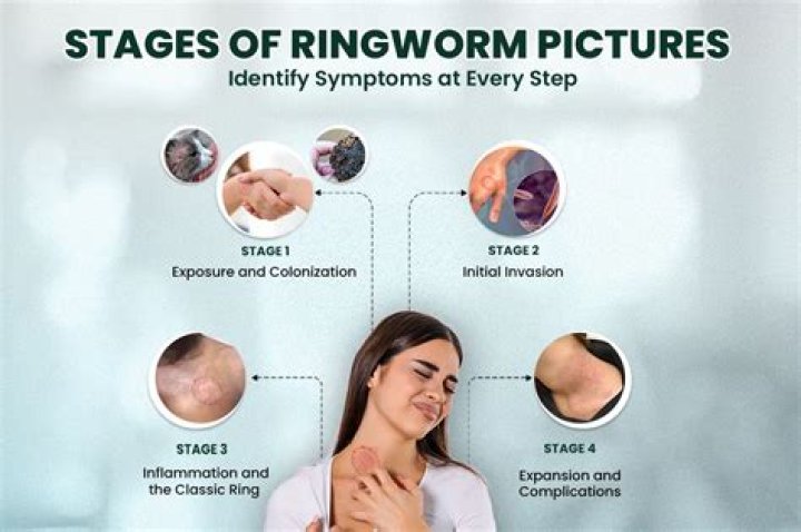 Is a ringworm a fungus?