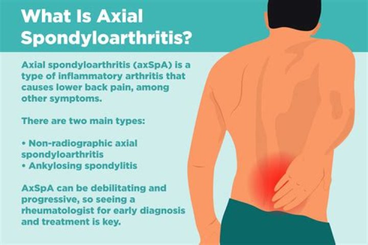 Is axial spondyloarthritis serious?