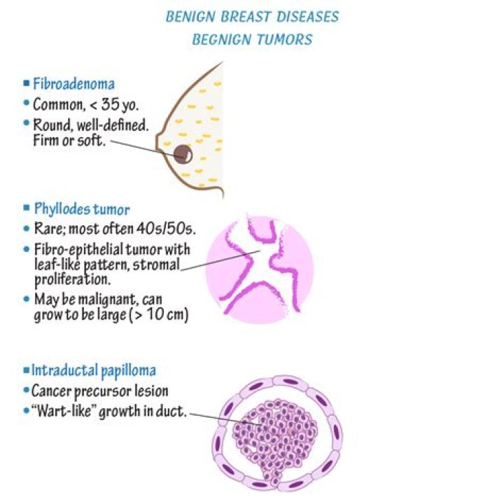 Is benign breast disease cancerous?